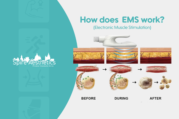 EMS treatment for post pregnancy weight loss treatment Wokingham