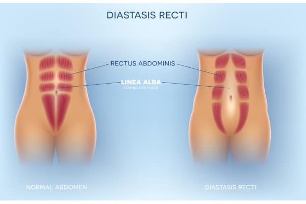What Non-Surgical Options Are Available for Diastasis Recti Wokingham?