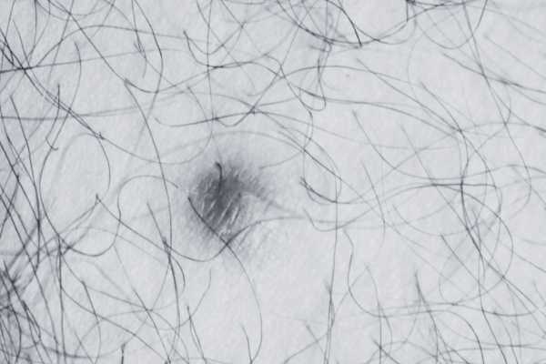 Dermatofibroma removal Wokingham made simple! Book in today!