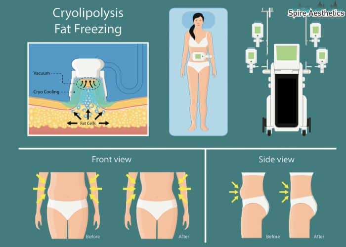 Image of diet and fat freezing combined for best results for Spire Aesthetics Wokingham
