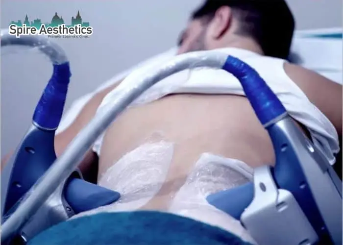 Man having fat freezing treatment done on love handles before a competitions Wokingham to create a sculpted look.
