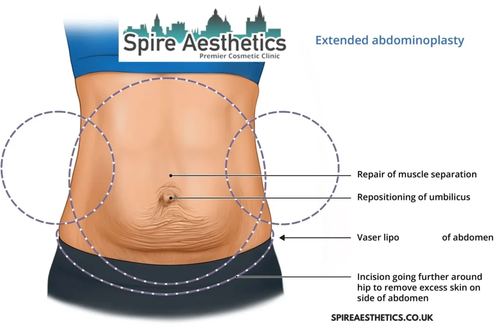 Understanding Loose Skin After Gastric Band Wokingham Surgery and HIFU Treatment