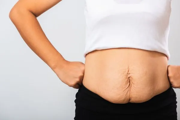 Image of a woman's stomach after weight loss with sagging skin following a gastric band Wokingham