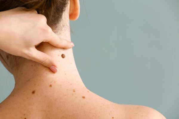 skin blemish removal Wokingham treatment