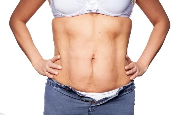 sagging skin on woman's stomach after weight loss injections Wokingham
