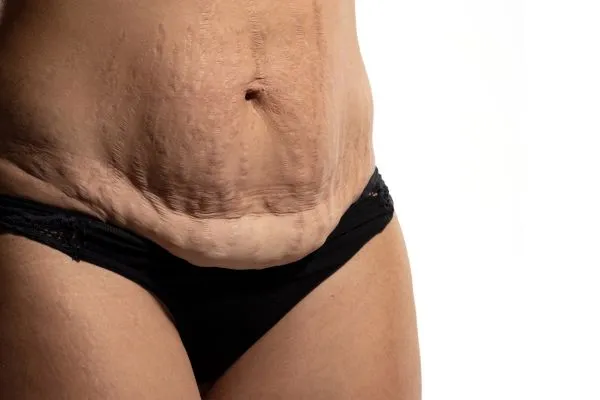 Image of womans stomach after weight loss injections Wokingham showing saggy skin