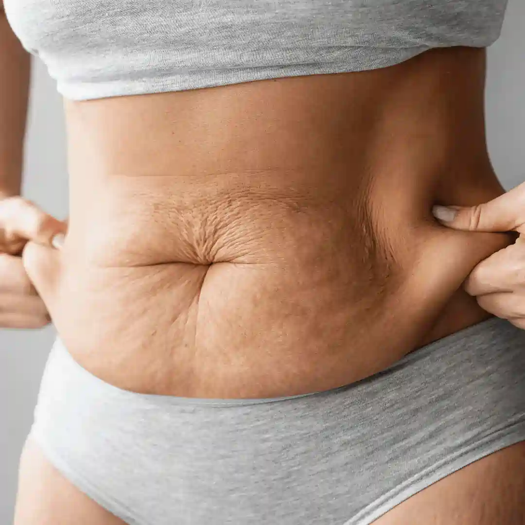 Is It Normal to Have Loose Skin After Pregnancy Wokingham?