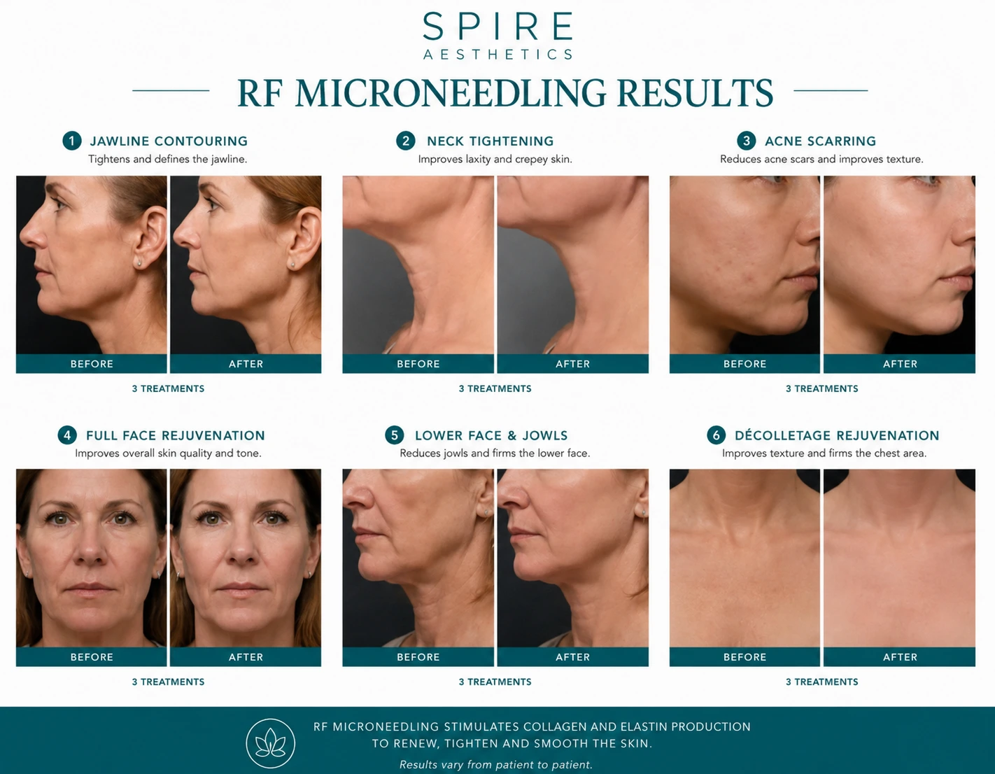 RF Microneedling Skin tightening Wokingham results