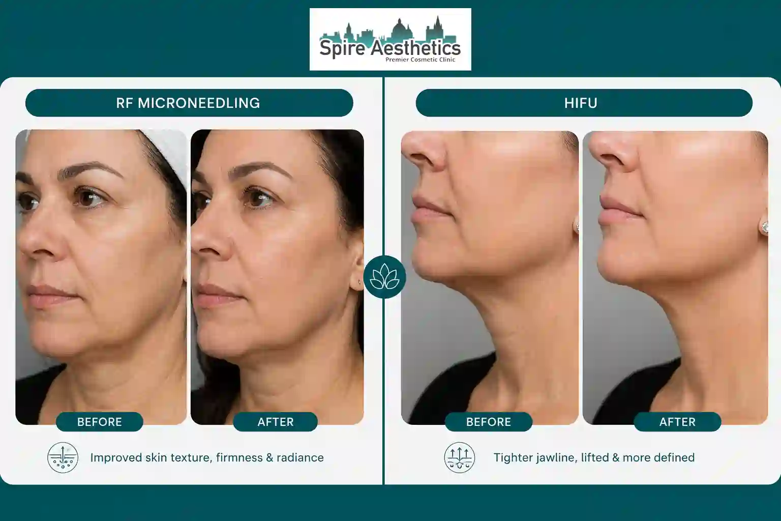 Can RF Microneedling and HIFU Be Combined Wokingham?