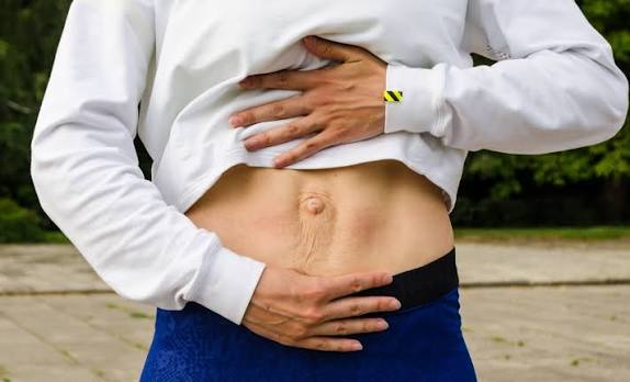 When Could Diastasis Recti Be the Missing Piece of the Puzzle Wokingham?